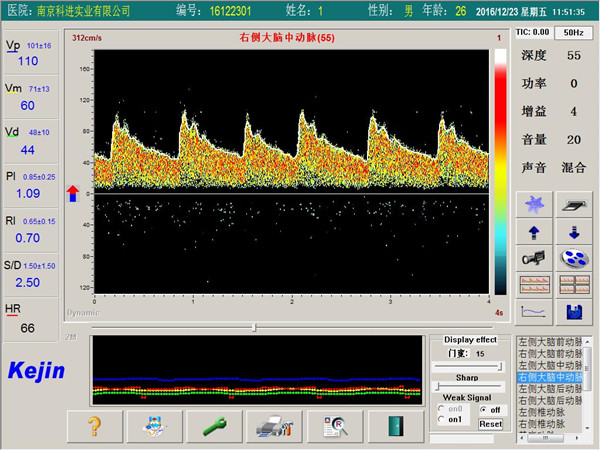 超聲經顱多普勒血流分析儀檢測界面.jpg