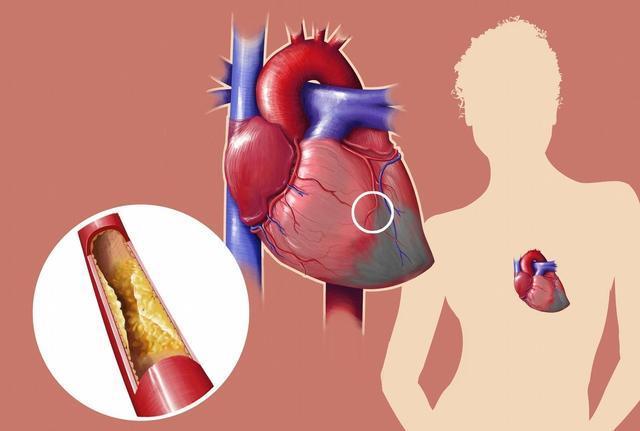 高血脂究是如何引發腦血管疾病的 高血脂究是如何引發腦血管疾病的