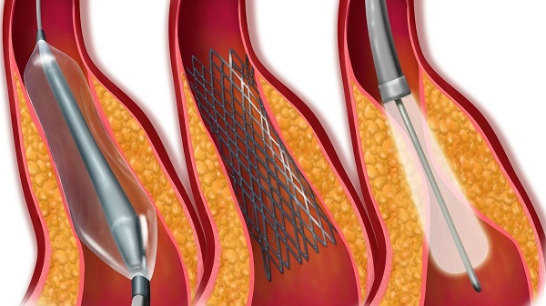 哪些檢查方法可以發(fā)現(xiàn)腦動(dòng)脈狹窄 哪些檢查方法可以發(fā)現(xiàn)腦動(dòng)脈狹窄