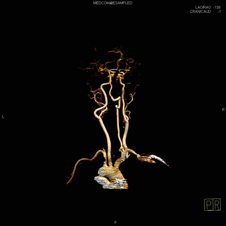 鎖骨下動脈盜血綜合征是怎樣一種疾病 鎖骨下動脈盜血綜合征是怎樣一種疾病